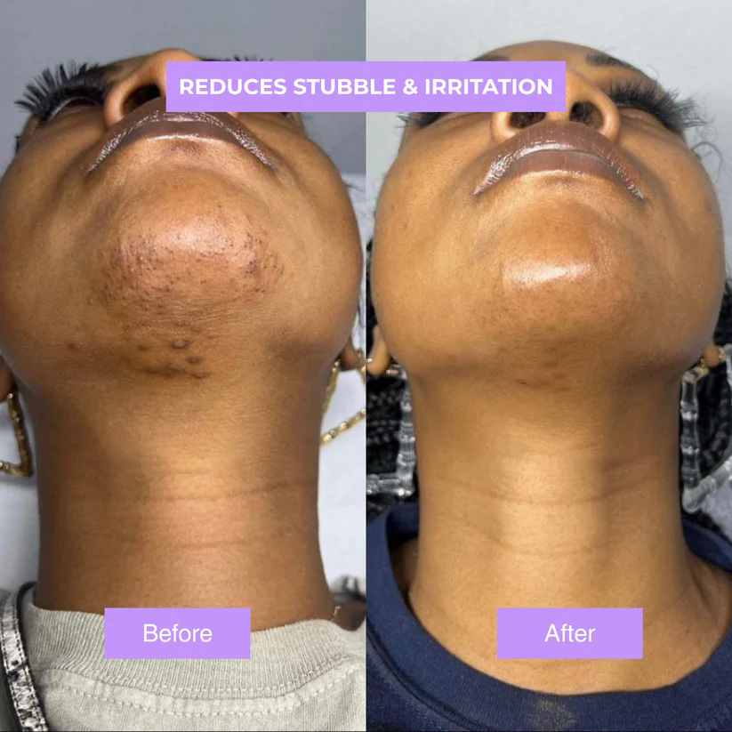 Chicluno™ - Cyperus Rotundus Skin Serum