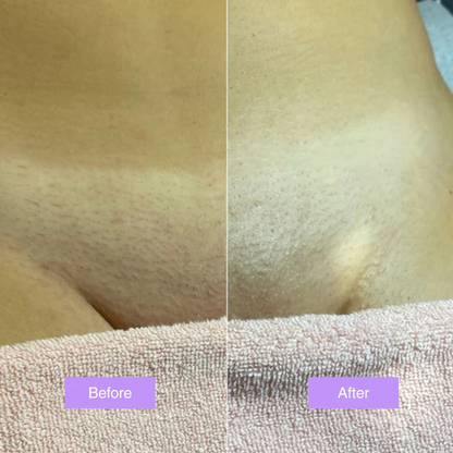 Chicluno™ - Cyperus Rotundus Skin Serum