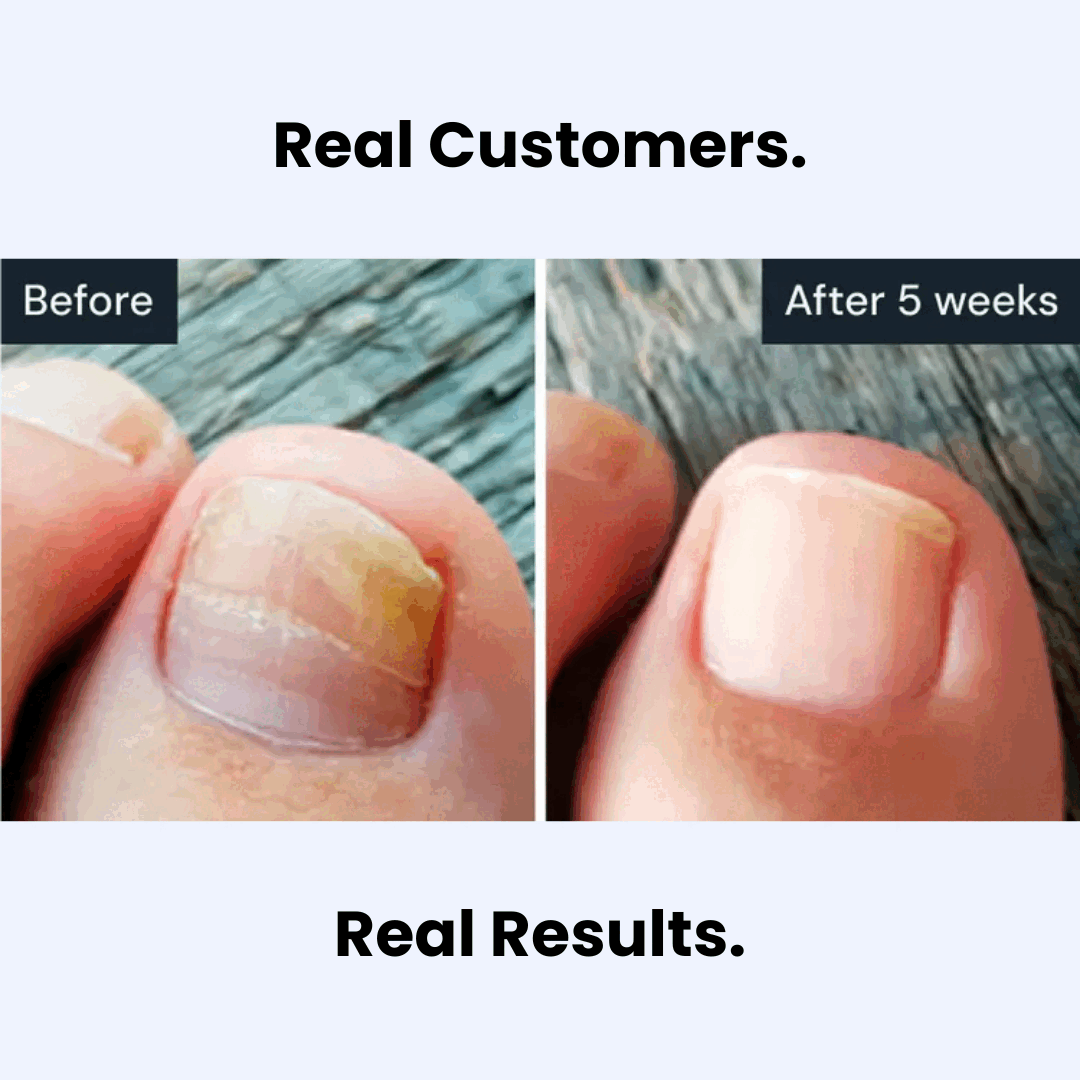 Chicluno™ Antifungal Pen