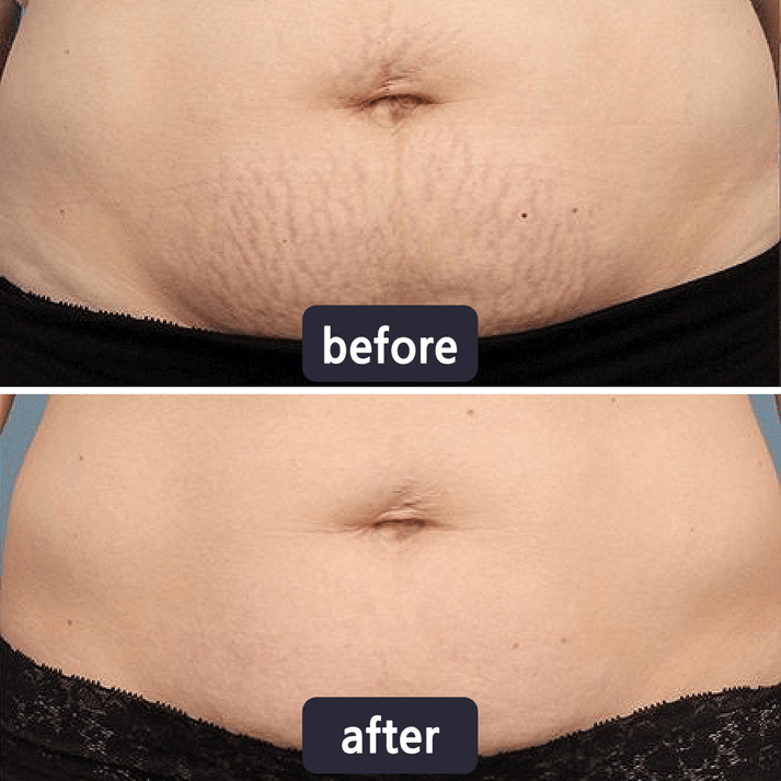 Chicluno Scar Removal Cream