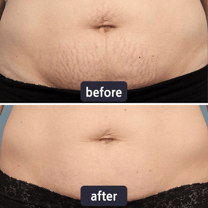 Chicluno Scar Removal Cream