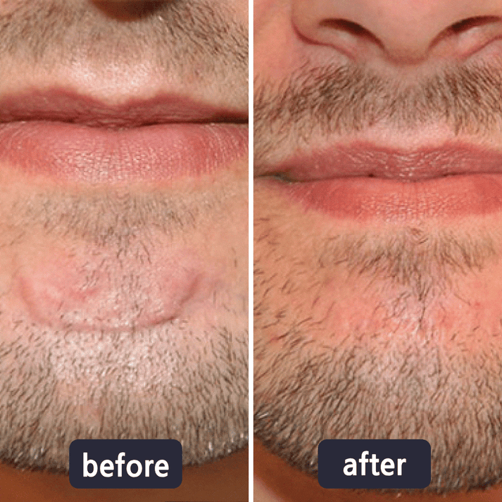 Chicluno Scar Removal Cream
