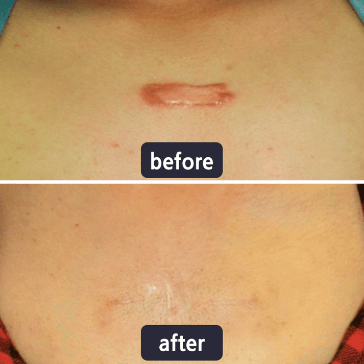 Chicluno Scar Removal Cream