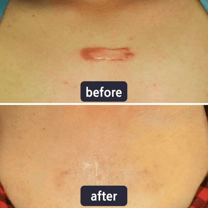 Chicluno Scar Removal Cream